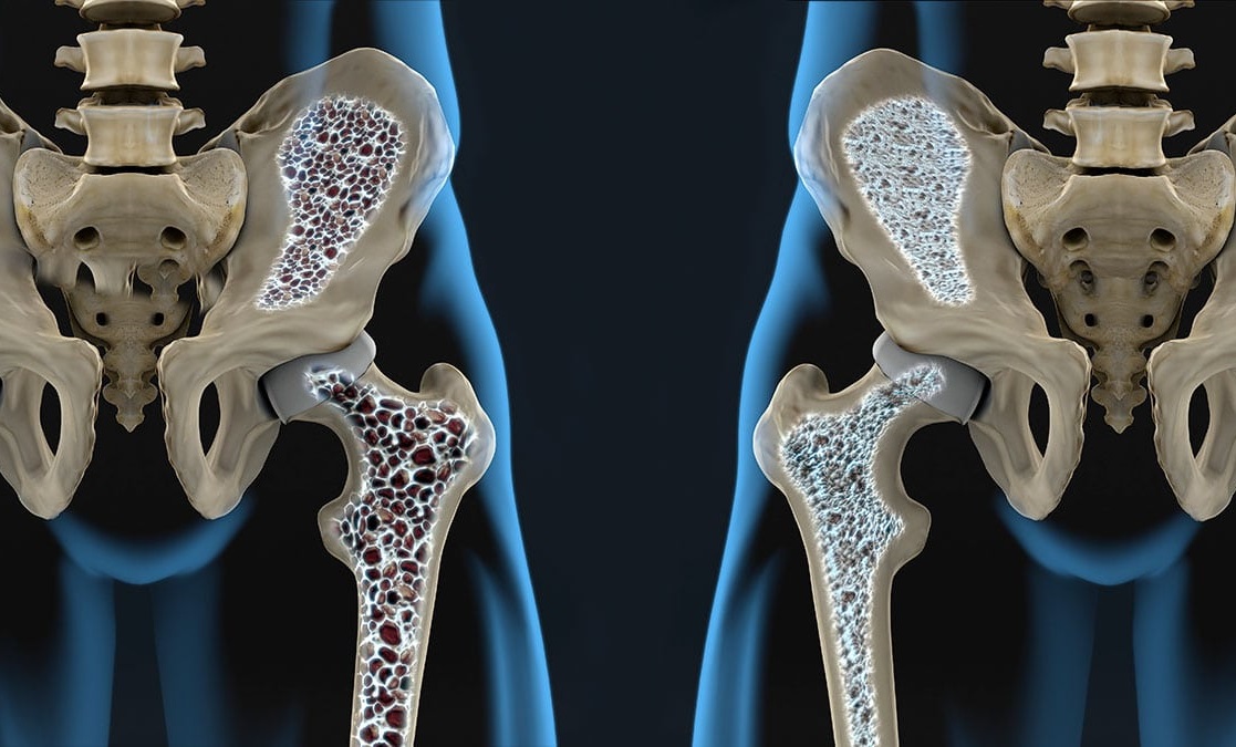 Osteoporosis y Trastornos del Calcio y Fósforo